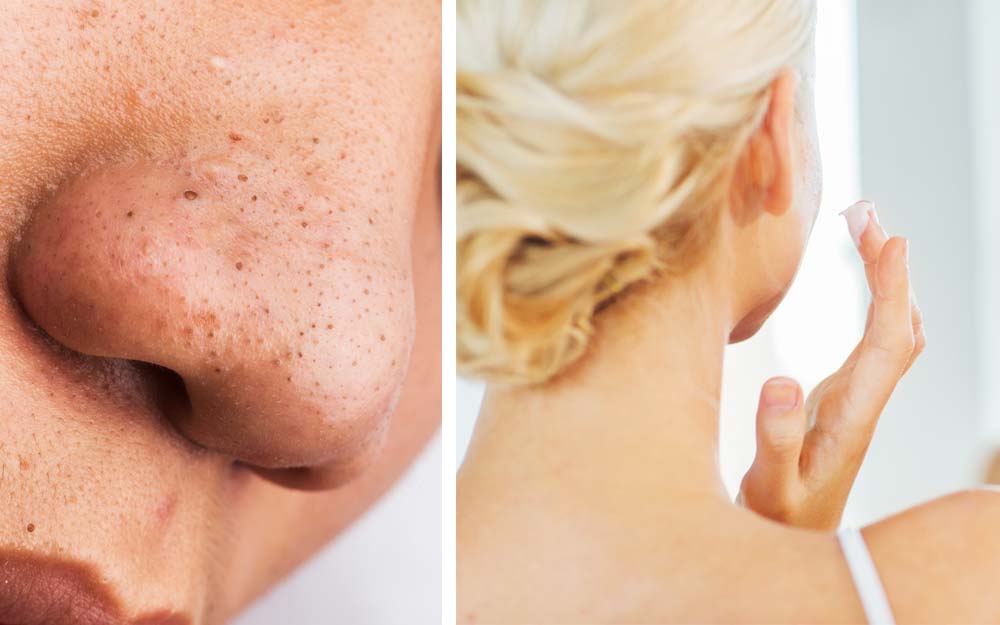 Cách trị Mụn Đầu Đen an toàn, hiệu quả tại nhà