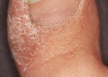Tại sao bạn không nên chủ quan với bệnh á sừng?