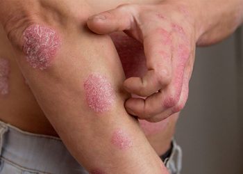 Cách chữa bệnh á sừng cực hiệu quả, bạn đã biết chưa?