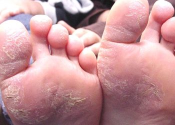 Nguyên nhân và cách chữa bệnh á sừng hiệu quả