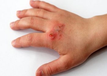 Di chứng của bỏng có nguy hiểm không và cách điều trị ra sao?