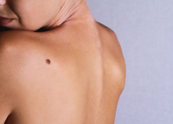 Nốt ruồi hình thành thế nào trên cơ thể của bạn?