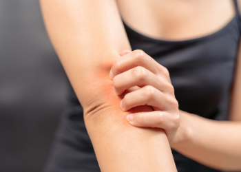 Dấu hiệu và phương pháp điều trị dứt điểm bệnh ghẻ ở người?