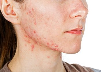 Viêm da tiếp xúc: Nguyên nhân, triệu chứng và phương pháp điều trị