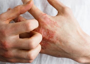 Tìm hiểu về viêm da tiếp xúc và biện pháp phòng ngừa