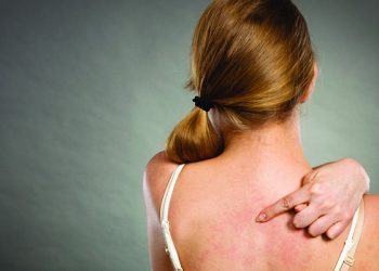 Tình trạng viêm da cơ địa tái đi tái lại nhiều lần và cách khắc phục