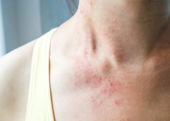 Viêm da cơ địa có chữa được không, cách phòng tránh thế nào?