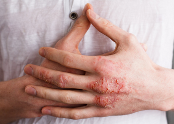 Viêm da tiếp xúc là bệnh gì? Có chữa trị tại nhà được không?