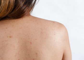 Vị trí thường bị kén nang lông và cách điều trị hiệu quả