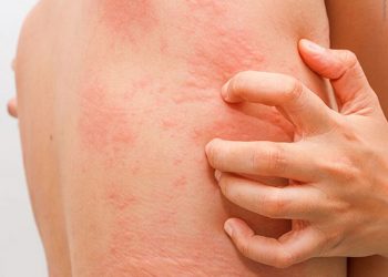 Nổi mề đay toàn thân nguy hiểm không – thắc mắc của nhiều người