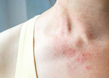 Chuyên gia Da liễu chỉ ra các dấu hiệu bị viêm da điển hình