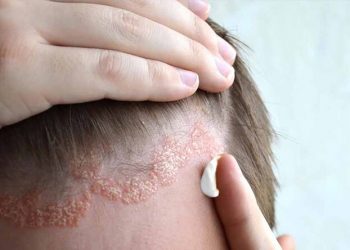 Các bệnh về da đầu ở nam giới – 5 bệnh lý phổ biến nhất
