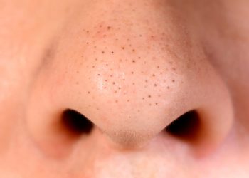 Nguyên nhân và cách trị mụn đầu đen trên mặt hiệu quả