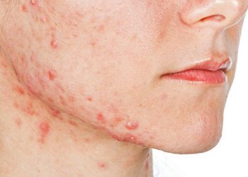 Lời khuyên của bác sĩ: Nên làm gì khi bị viêm nang lông?
