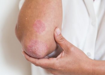 Bệnh chàm có lây không và những điều bạn cần biết