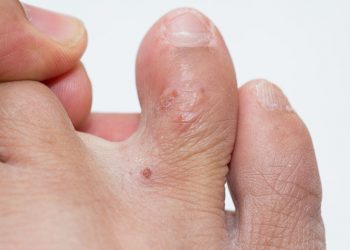 Top các triệu chứng bệnh tổ đỉa dễ nhận biết nhất