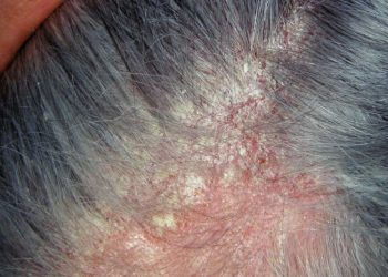 Góc giải đáp: Làm thế nào khi bị nấm da đầu?
