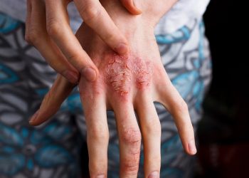 Nguyên nhân gây bệnh viêm da cơ địa và những biến chứng nguy hại