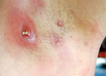 Nguyên nhân gây nổi mụn ở nách và cách điều trị hiệu quả