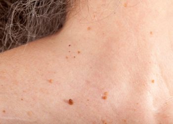 Bác sĩ giải đáp: Mụn thịt có gây ra biến chứng không?