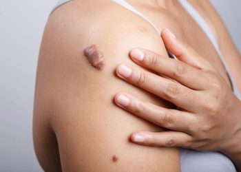 Sẹo lồi hình thành như thế nào? Phương pháp điều trị ra sao?