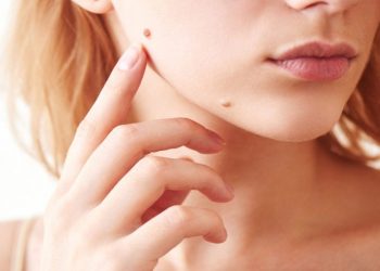 Đốt nốt ruồi có an toàn không và cần lưu ý những gì?