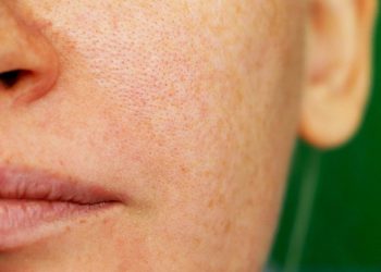 Mách bạn những cách làm sạch lỗ chân lông mở rộng