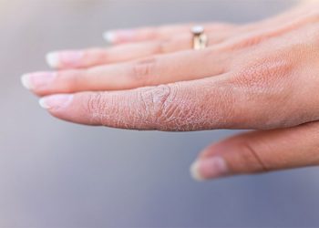 Điều trị tình trạng da khô nghiêm trọng như thế nào?
