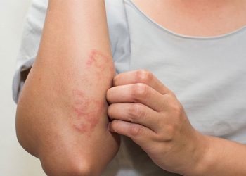 Mách bạn những cách giảm ngứa bệnh viêm da cơ địa