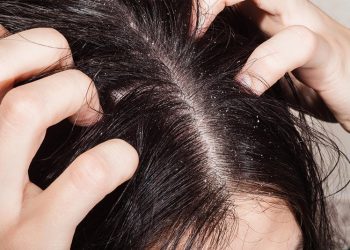 Những nguyên nhân gây ngứa da đầu và cách điều trị hiệu quả