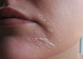 Điểm danh những nguyên nhân bong tróc da mặt và cách khắc phục hiệu quả