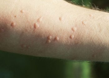 Các nguyên nhân gây nổi mề đay thường gặp nhất