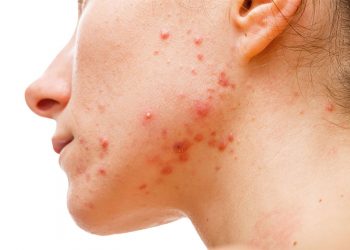 Muốn trị bệnh mụn trứng cá, bạn đừng bỏ qua những điều này