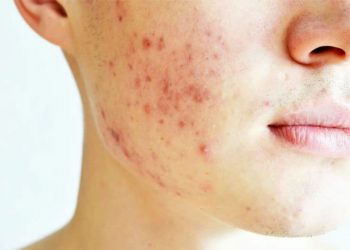 Những lưu ý khi dùng thuốc uống trị mụn bạn nên biết
