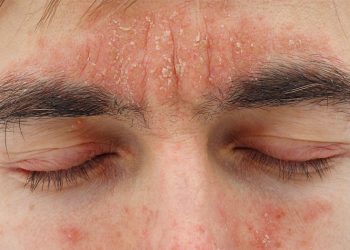 Viêm da dầu – căn bệnh gây khó chịu và mất thẩm mỹ