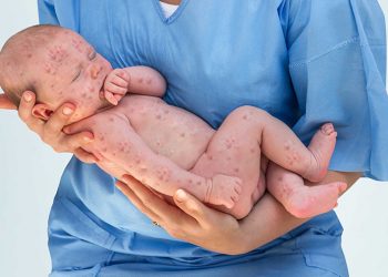 Các phát ban nhiễm trùng thường gặp: cách nhận biết và điều trị