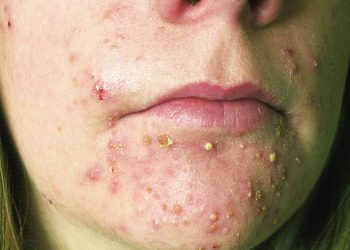 Giải đáp: Mụn trứng cá có bao nhiêu cấp độ?