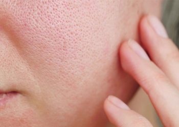 Tình trạng lỗ chân lông mặt to có thể cải thiện bằng cách nào?