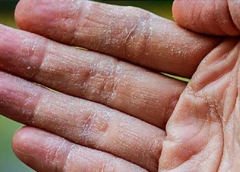 Dấu hiệu, nguyên nhân và cách điều trị viêm da á sừng