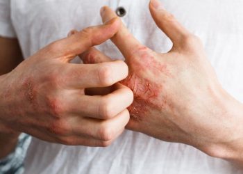 Các yếu tố nguy cơ gây bệnh chàm và những loại chàm thường gặp