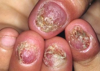 Cách điều trị dứt điểm nấm móng tay, móng chân đơn giản và hiệu quả