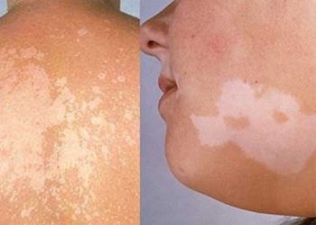 Bệnh lang ben là gì? Cách điều trị lang ben ra sao?