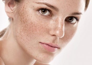 Đi tìm lời giải cho băn khoăn nám tàn nhang lâu năm có chữa được không