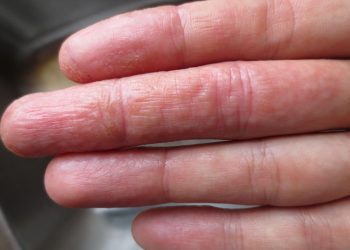Góc tư vấn: Có nên điều trị tổ đỉa tại nhà không?
