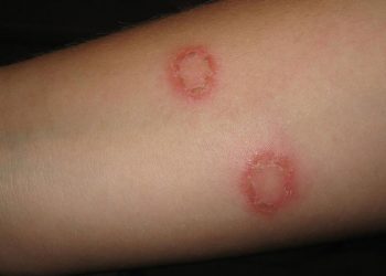 Cách điều trị dứt điểm nấm hắc lào hiệu quả