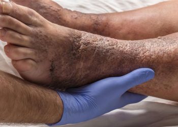 Viêm da cổ chân do đâu? Các giải pháp điều trị bệnh?