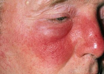 Viêm quầng đỏ là bệnh gì? Cách điều trị như thế nào?