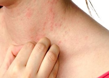 Góc giải đáp: Nổi mề đay tự khỏi không và cách điều trị bệnh