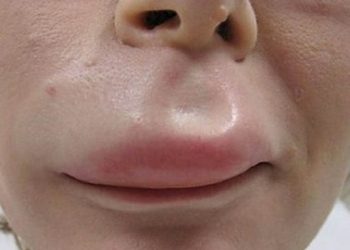 Tất tần tật mọi điều cần biết về hội chứng dị ứng miệng