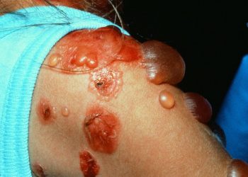 Triệu chứng, phân loại và cách điều trị bệnh Pemphigus hiệu quả